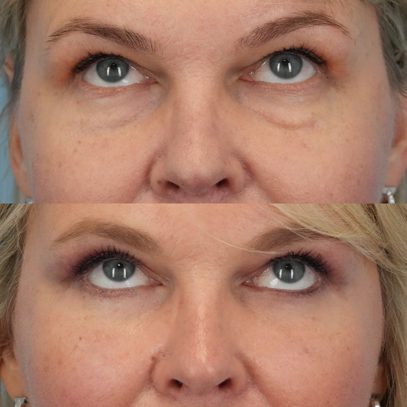 Before and after photo of woman who received Puregraft fat grafting on her under eye