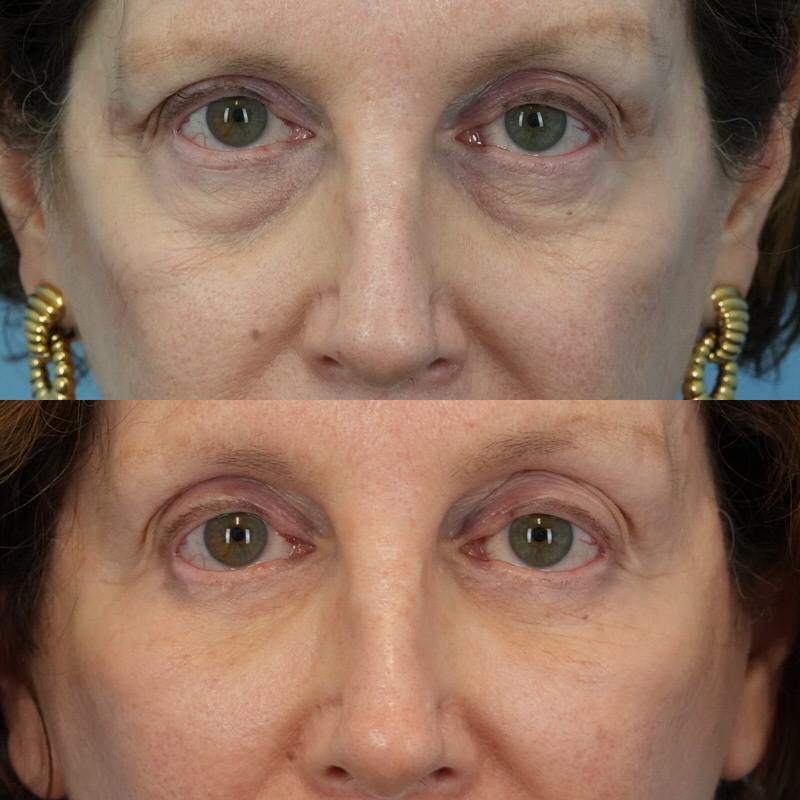 Before and after photo of woman who received Puregraft fat grafting in her under eye area
