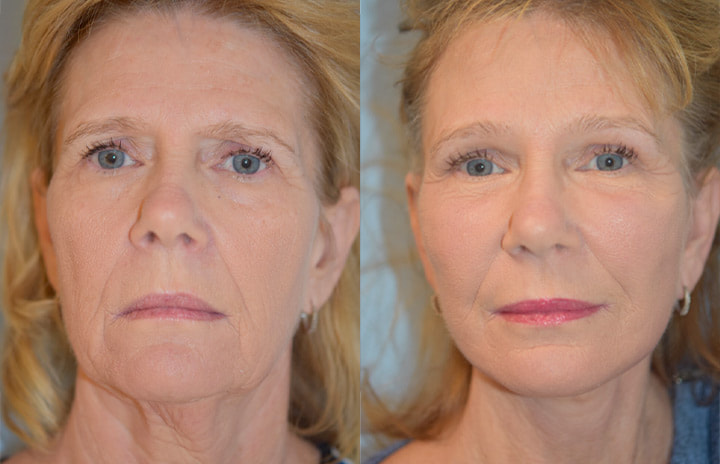 Before & After Face with puregraft