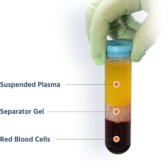 Vile with seperations of suspended plasma, separator gel, and red blood cells