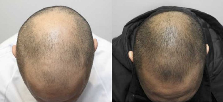 Male patient before and after receving Kerastem