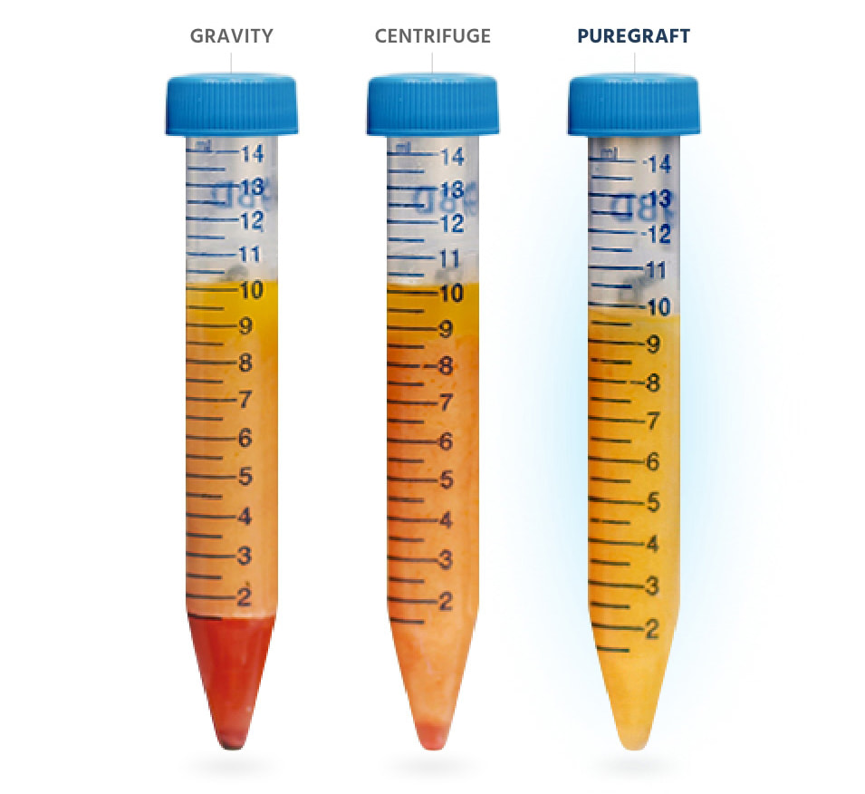 Comparing fat viles between gravity, centrifuge, and puregraft with puregraft having the most fat vs blood