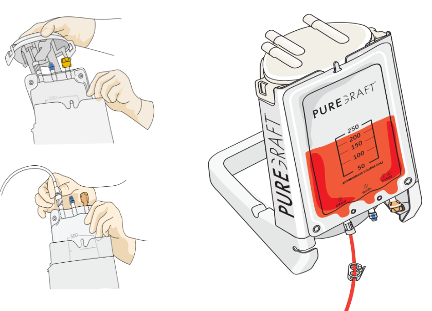 Puregraft® SYNC™ Adipose Filtration System