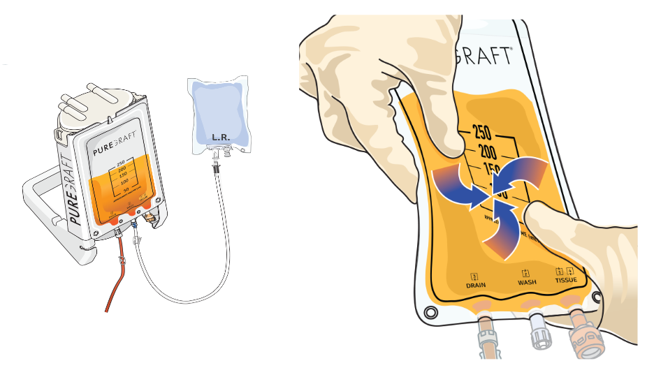 Puregraft® SYNC™ Adipose Filtration System