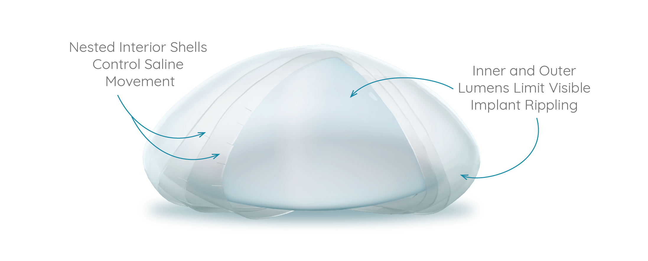 The layers of a Serene breast implant